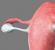 Nosečnost z eno cevjo Navzkrižna ovulacija