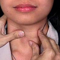 Состояние после удаления щитовидной железы
